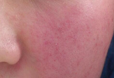 如何拯救你的敏感??？廣西南寧美容培訓叫你正確方法