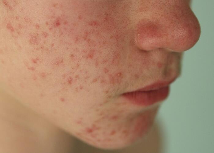 粉刺閉口應(yīng)該如何處理？