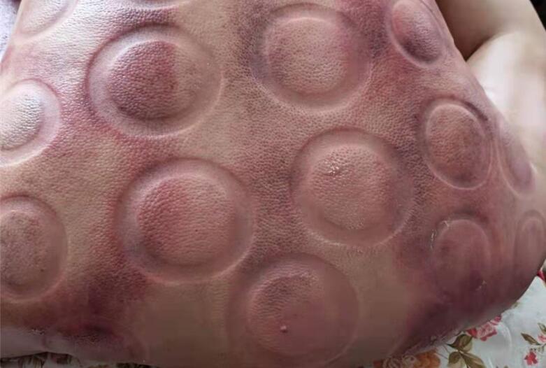 怎樣拔火罐？南寧美容學(xué)校手把手教你