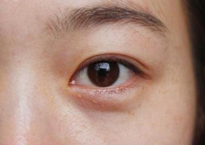 黑眼圈的種類有哪些？廣西美容培訓教你保養(yǎng)