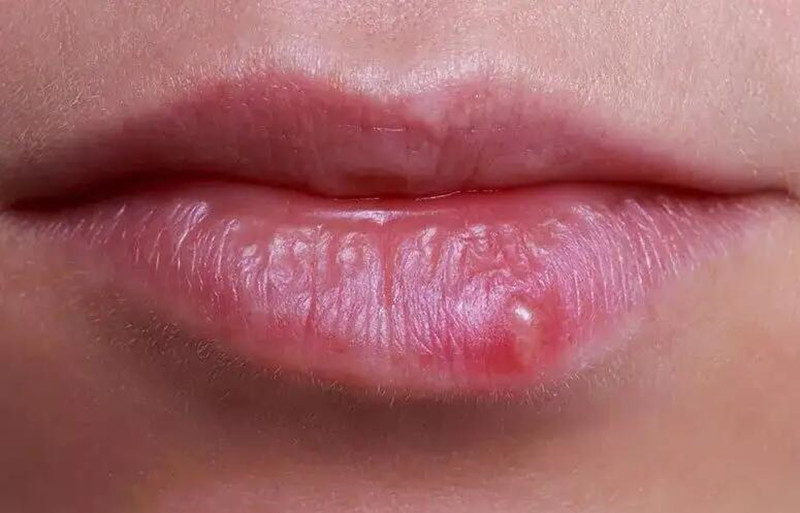 紋唇后起泡怎么辦？南寧紋唇培訓學校教你方法
