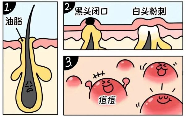 不同部位閉口形成的原因，南寧美容護膚學(xué)校解答